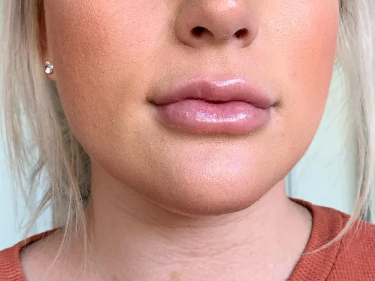 Juvederm lip filler gives you the pout you've always wanted.
