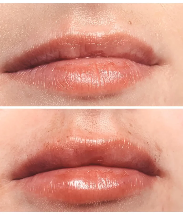 The effects of Juvederm lip filler are immediate.
