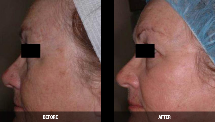 CO2 laser resurfacing reduces fine lines and sun damage.