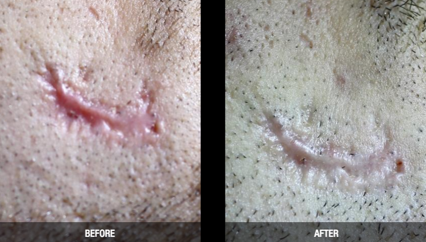 CO2 laser resurfacing make scars less noticeable with only one treatment.
