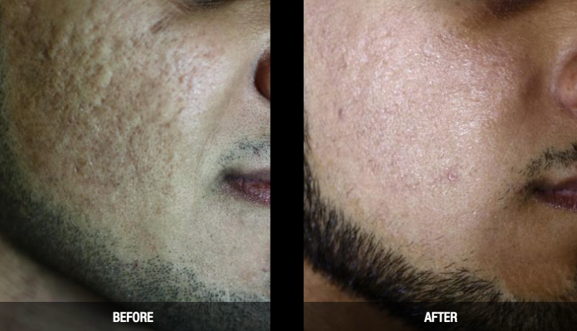 CO2 laser resurfacing diminishes scarring with just one treatment.