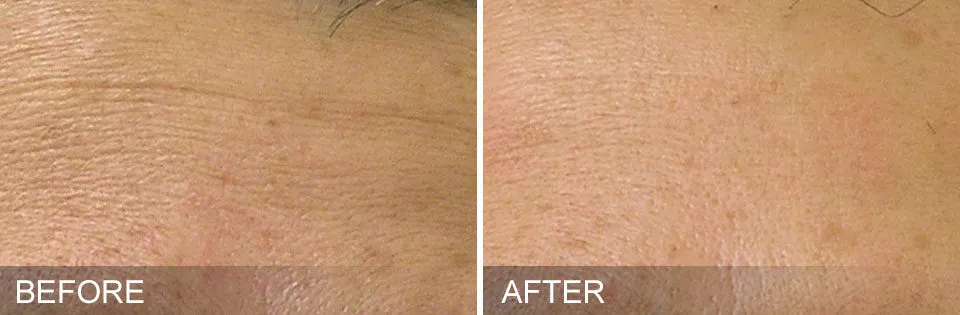HydraFacials improve fine lines and wrinkles to give you a more youthful appearance.