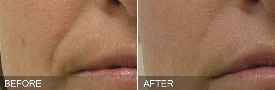 Fine lines and wrinkles become less visible with HydraFacial treatments.