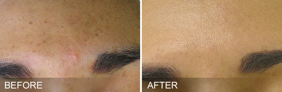 HydraFacial treatments reduce the appearance of brown spots and evens skin tone.