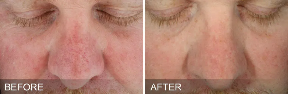 A HydraFacial treatment reduces facial redness.