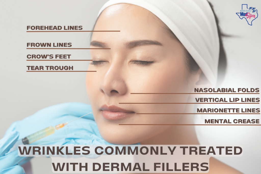 Wrinkles commonly treated with dermal fillers