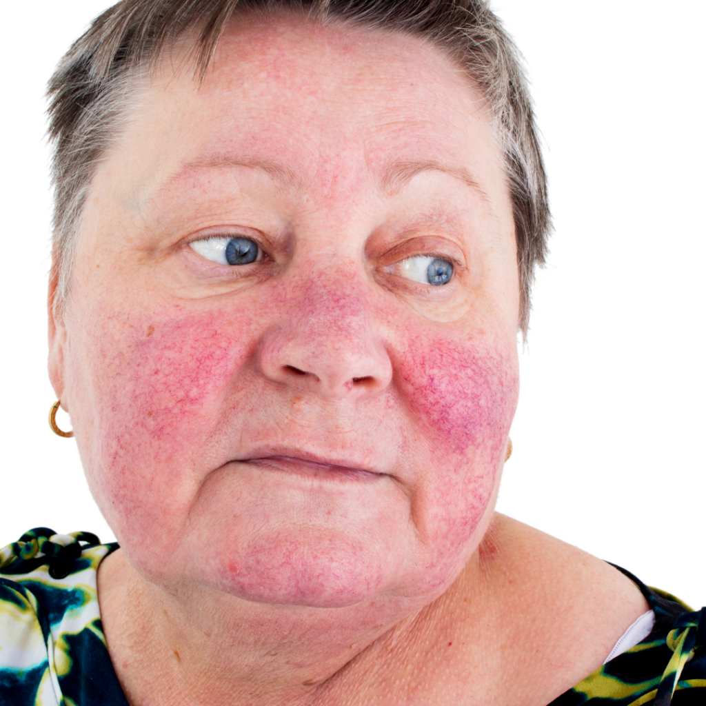 Rosacea Type 1