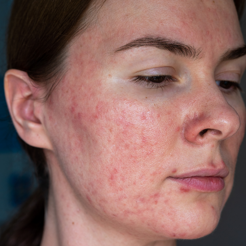 Rosacea Type 2