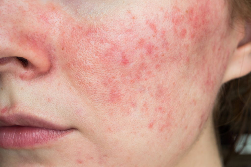 Understanding rosacea types