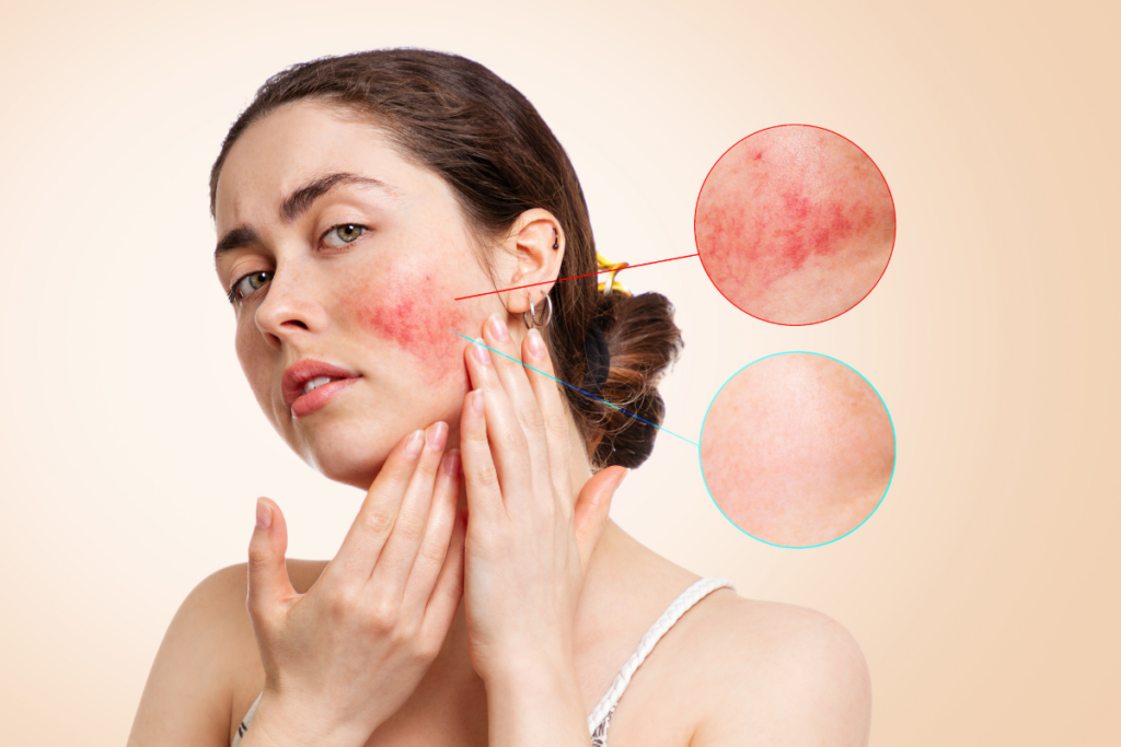 What types of rosacea do you have?