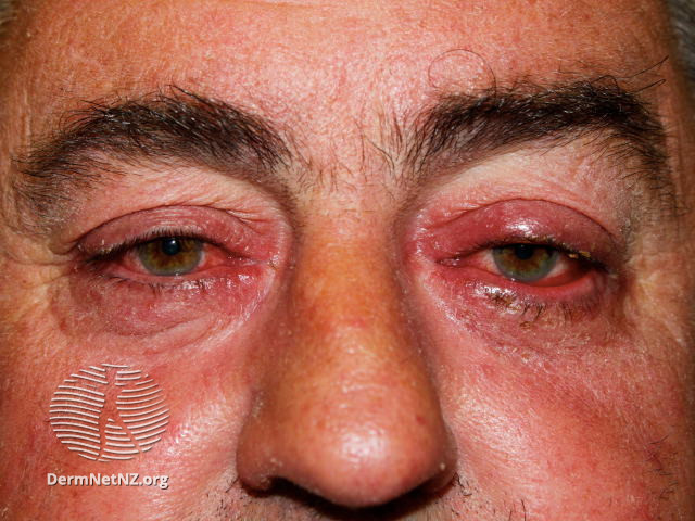 Ocular Rosacea from Dermnet