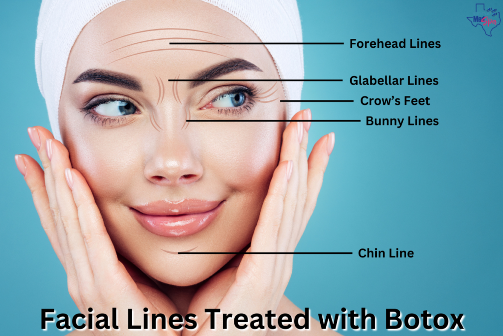 Facial Lines Treated with Botox