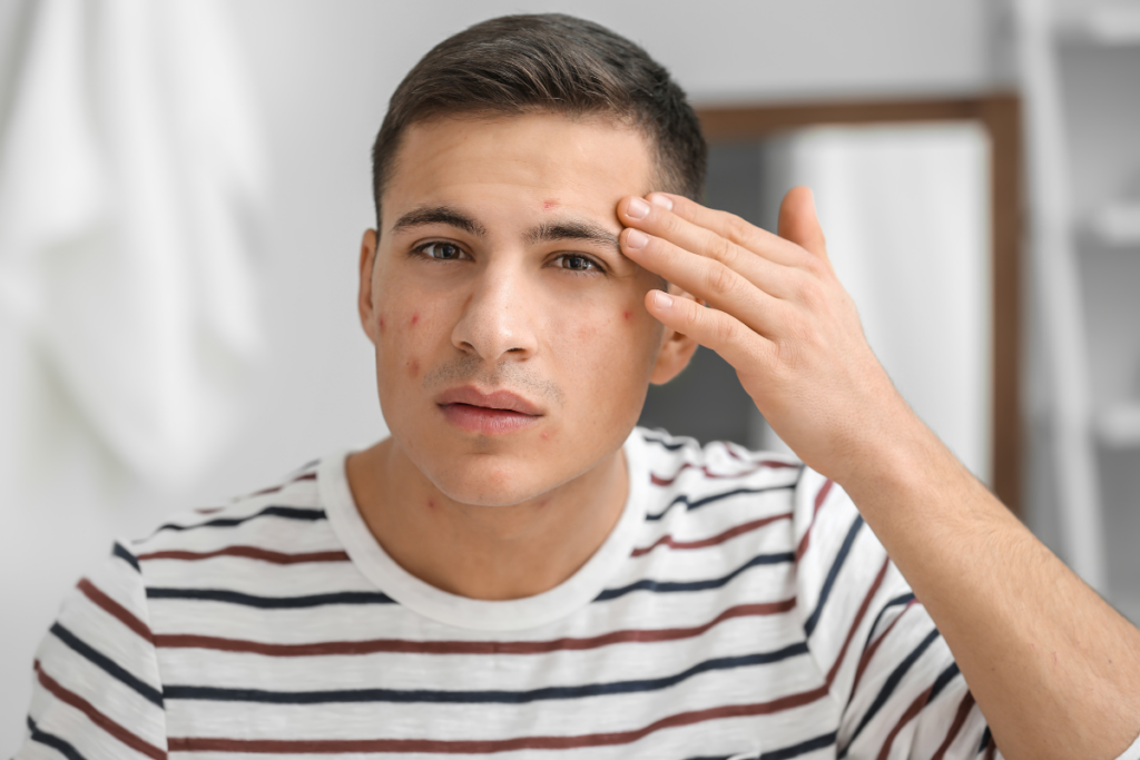 Adult man looking at acne on face