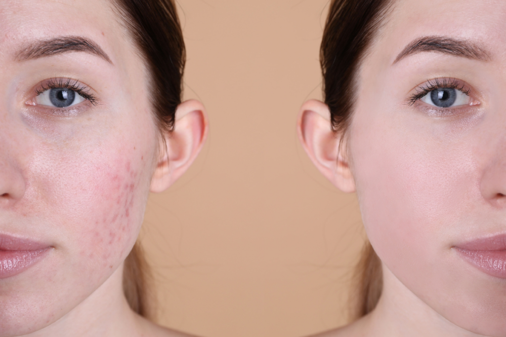 Before and after of a woman with acne