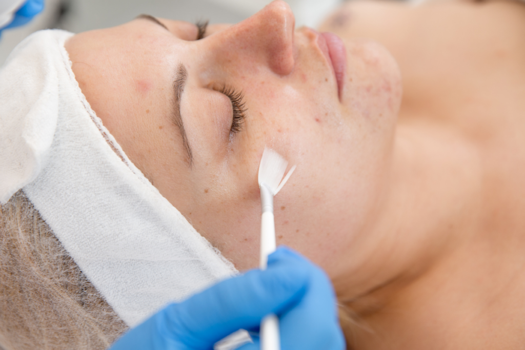 Woman receiving facials for acne, including a chemical peel