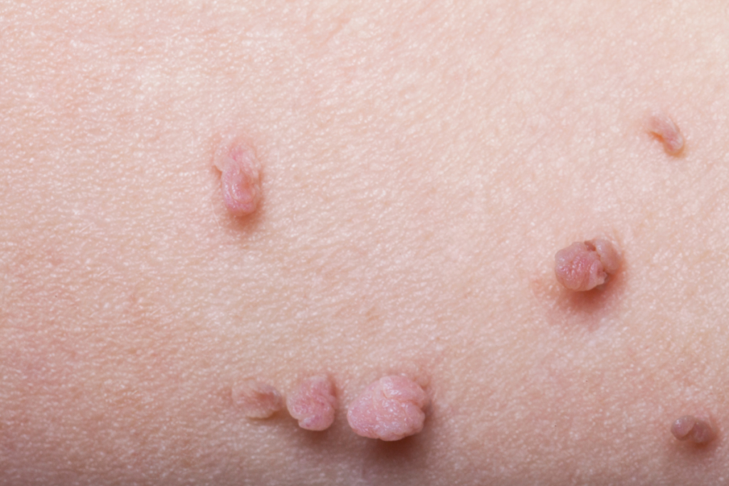 Person with multiple skin tags