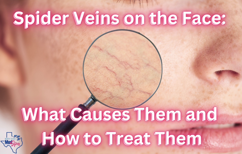 Spider Veins on Face (header)