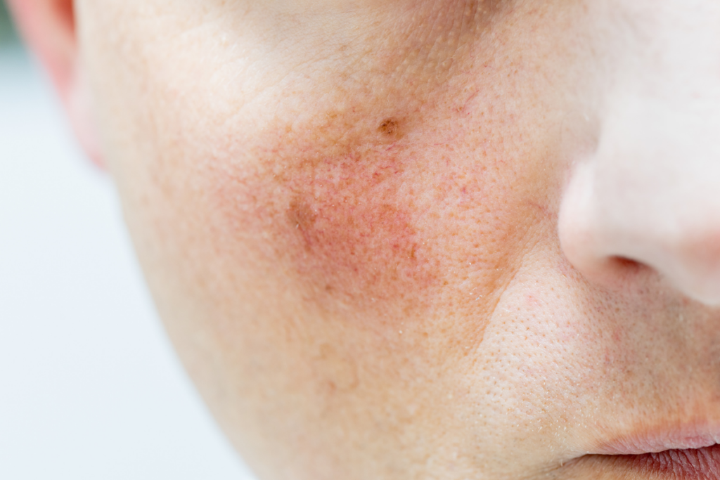 spider veins on face