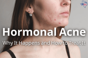Hormonal Acne (header)