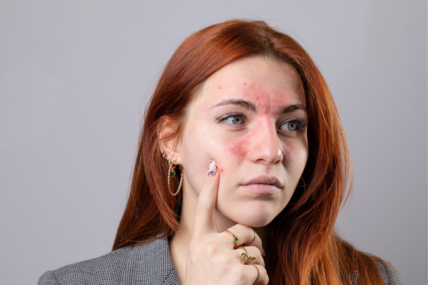 A young woman dealing with uneven skin tone and texture issues from rosacea