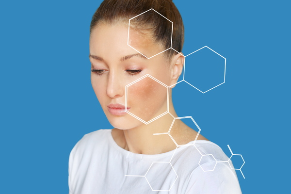 Woman representing a visual concept of underlying skin tone issues and damage