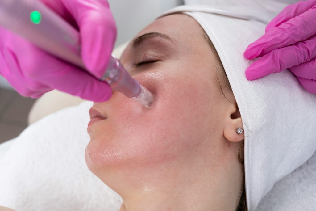 Woman receiving Microneedling full face treatment, photo by Corinne Sawers on Unsplash — 2LxO1Wef8wQ-unsplash