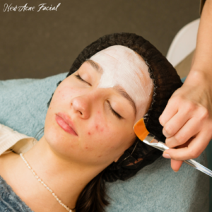 Acne Facial special