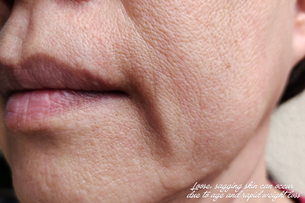 Sagging skin that could be improved with skin tightening after weight loss treatments